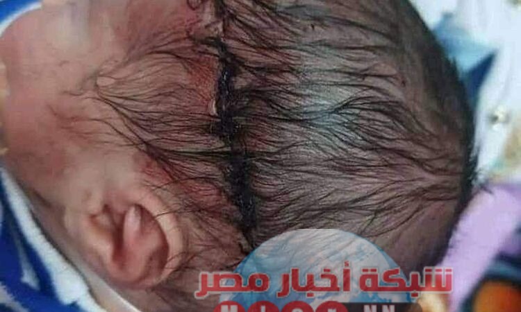 إصابة طفل حديث الولادة بقطع ف الرأس أثناء إجراء ولادة قيصرية بسوهاج 1641590358 0